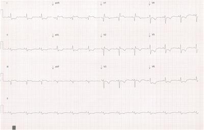 Case report: Polyarteritis nodosa as a substrate for a massive myocardial infarction